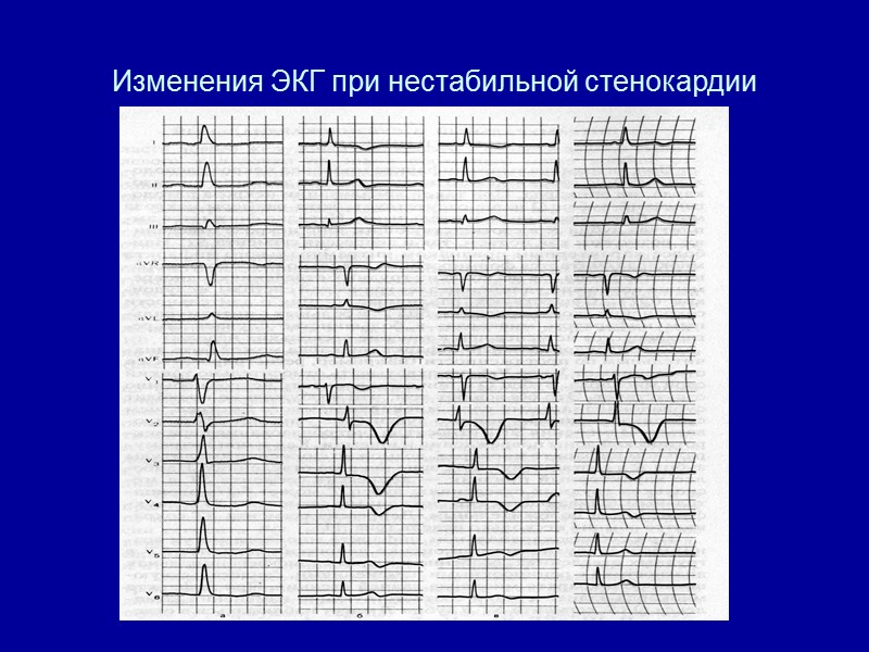 Изменения ЭКГ при нестабильной стенокардии